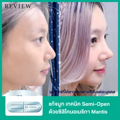 แก้จมูก เทคนิค Semi-Open ด้วยซิลิโคนอเมริกา Mantis