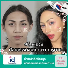 ค่ามัดจำตัดปีกจมูก ซ่อนรอยแผล เทคนิคเกาหลี สำหรับเคสทำครั้งแรก