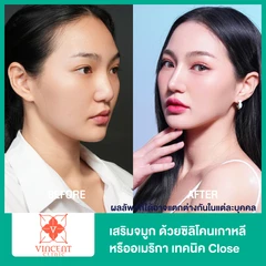 เสริมจมูก ด้วยซิลิโคนเกาหลีหรืออเมริกา เทคนิค Close สำหรับเคสทำครั้งแรก