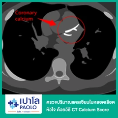 ตรวจปริมาณแคลเซียมในหลอดเลือดหัวใจ ด้วยวิธี CT Calcium Score ที่ โรงพยาบาลเปาโล รังสิต