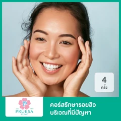 คอร์สรักษารอยสิว บริเวณที่มีปัญหา (Junior Acne Scar Program) 4 ครั้ง