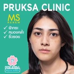 ทำทรีตเมนต์ MS Renew Program ลดริ้วรอย กระชับรูขุมขน เพิ่มความกระจ่างใส 1 ครั้ง