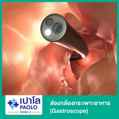 ส่องกล้องกระเพาะอาหาร (Gastroscope)