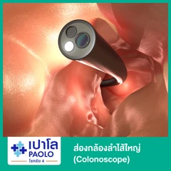 ส่องกล้องลำไส้ใหญ่ (Colonoscope)