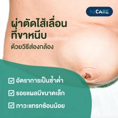 ผ่าตัดไส้เลื่อนที่ขาหนีบ ด้วยวิธีส่องกล้อง (Laparoscopic Inguinal Hernia Repair)