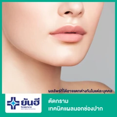 ตัดกราม เทคนิคแผลนอกช่องปาก พักฟื้นรพ. 2 คืน