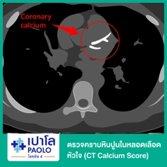 ตรวจคราบหินปูนในหลอดเลือดหัวใจ (CT Calcium Score)