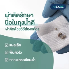 ผ่าตัดรักษานิ่วในถุงน้ำดีด้วยวิธีการส่องกล้อง