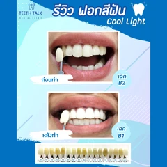 ฟอกสีฟันที่คลินิก ด้วยระบบ Cool Light