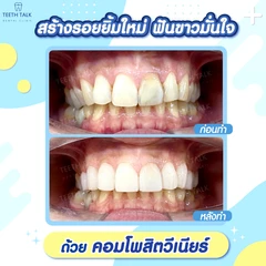 ทำวีเนียร์คอมโพสิต สำหรับฟัน 1 ซี่