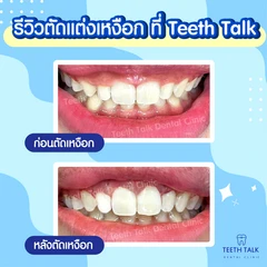 ตัดแต่งเหงือก เคสไม่กรอกระดูก สำหรับฟัน 1 ซี่