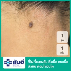 จี้ไฝ ขี้แมลงวัน ติ่งเนื้อ กระเนื้อ สิวหิน ต่อมไขมันโต ด้วยเลเซอร์ CO2 1 จุด 1 ครั้ง