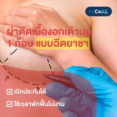 ผ่าตัดเนื้องอกเต้านม 1 ก้อน