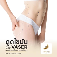 ดูดไขมันด้วยเครื่อง VASER เลือก 1 บริเวณ หน้าท้องบน หน้าท้องล่าง แขน ขา หรือสะโพก สำหรับผู้ที่มีค่า BMI ไม่เกิน 30 นอนพักที่ รพ. 1 คืน