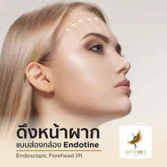 ผ่าตัดดึงหน้าผากด้วย Endotine แบบส่องกล้อง สำหรับเคสทำครั้งแรก นอนพักที่ รพ. 1 คืน