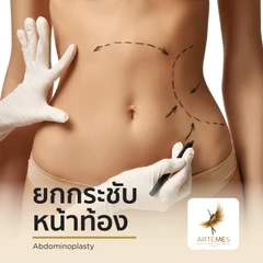 ผ่าตัดยกกระชับหน้าท้อง สำหรับผู้ที่มีค่า BMI ไม่เกิน 30 สำหรับเคสทำครั้งแรก นอนพักที่ รพ. 2 คืน