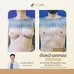 ตัดหน้าอก สำหรับผู้ที่มีขนาดหน้าอกคัพ D เทคนิคขึ้นอยู่กับแพทย์ประเมิน สำหรับเคสทำครั้งแรก นอนพักที่ รพ. 2 คืน