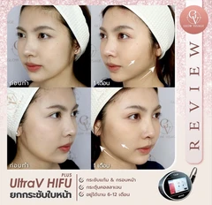 ทำ HIFU ด้วยเครื่อง Ultra V HIFU Plus ไม่จำกัดช็อต ขึ้นอยู่กับแพทย์ประเมิน เพื่อยกกระชับใบหน้า รวมเหนียง 1 ครั้ง