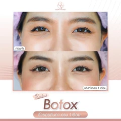 โปรแกรมโบท็อกซ์ จำนวนยูนิตขึ้นอยู่กับแพทย์ประเมิน (ลดริ้วรอย)