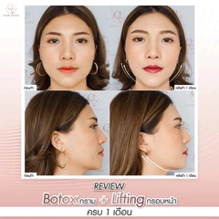 โปรแกรมโบท็อกซ์ จำนวนยูนิตขึ้นอยู่กับแพทย์ประเมิน (ลิฟกรอบหน้า)