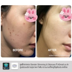 คอร์สฉายแสงฆ่าเชื้อสิว ด้วย Blue Light Laser ลดการอักเสบ ทำให้สิวฝ่อและแห้งลง 2 ครั้ง