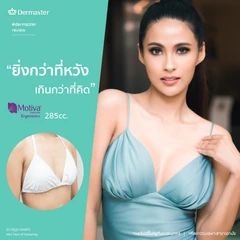 เสริมหน้าอกด้วยซิลิโคน Motiva Ergonomix รุ่นมีชิป ไม่จำกัดซีซี สำหรับเคสเสริมครั้งแรก