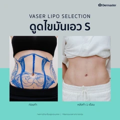 โปรแกรมดูดไขมันด้วยเครื่อง Vaser 4 จุด 1 ครั้ง สำหรับผู้ที่ BMI ไม่เกิน 25