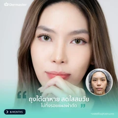 ศัลยกรรมถุงใต้ตา สำหรับเคสทำครั้งแรก