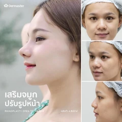 เสริมจมูก ด้วยซิลิโคนอเมริกาเกรดพรีเมียม เทคนิค Semi Open สำหรับเคสทำครั้งแรก