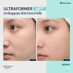 ทำ HIFU ด้วยเครื่อง Ultraformer MPT 300 ช็อต เพื่อยกกระชับ ปรับรูปหน้า 1 ครั้ง