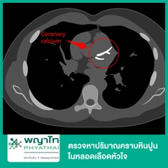 ตรวจหาปริมาณคราบหินปูนในหลอดเลือดหัวใจ (Calcium Scoring) ด้วยเครื่อง CT Scan