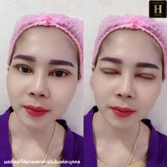 ทำตาสองชั้นแบบกรีดยาว พร้อมตัดไขมัน ตัดหนังตา และยกหางหงส์ สำหรับเคสทำครั้งแรกหรือเคสแก้