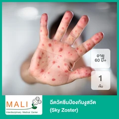 ฉีดวัคซีนป้องกันงูสวัด 1 เข็ม (Sky Zoster) สำหรับผู้ที่อายุ 60 ปีขึ้นไป