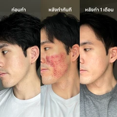 Discovery Pico เลเซอร์หน้าเพื่อผิวเรียบเนียน หลุมสิวตื้นขึ้น 1 ครั้ง