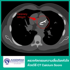 ตรวจคัดกรองความเสี่ยงโรคหัวใจ ด้วยวิธี CT Calcium Score