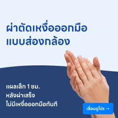 ผ่าตัดเหงื่อออกมือ