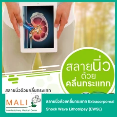 สลายนิ่วด้วยคลื่นกระแทก Extracorporeal Shock Wave Lithotripsy (EWSL) นอนพักที่ รพ. 2 วัน 1 คืน
