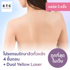 โปรแกรมรักษาสิวทั่วแผ่นหลัง 4 ขั้นตอน รวมเลเซอร์ Dual Yellow ทั่วใบหน้า 2 ครั้ง ฟรี! 1 ครั้ง