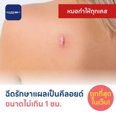 ฉีดรักษาแผลเป็นคีลอยด์ ขนาดเส้นผ่านศูนย์กลางไม่เกิน 1 ซม. 1 จุด 1 ครั้ง