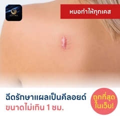 ฉีดรักษาแผลเป็นคีลอยด์ ขนาดเส้นผ่านศูนย์กลางไม่เกิน 1 ซม. 1 จุด 1 ครั้ง