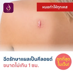 ฉีดรักษาแผลเป็นคีลอยด์ ขนาดเส้นผ่านศูนย์กลางไม่เกิน 1 ซม. 1 จุด 1 ครั้ง