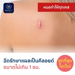 ฉีดรักษาแผลเป็นคีลอยด์ ขนาดเส้นผ่านศูนย์กลางไม่เกิน 1 ซม. 1 จุด 1 ครั้ง