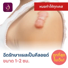 ฉีดรักษาแผลเป็นคีลอยด์ ขนาดเส้นผ่านศูนย์กลาง 1-2 ซม. 1 จุด 1 ครั้ง
