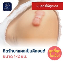 ฉีดรักษาแผลเป็นคีลอยด์ ขนาดเส้นผ่านศูนย์กลาง 1-2 ซม. 1 จุด 1 ครั้ง