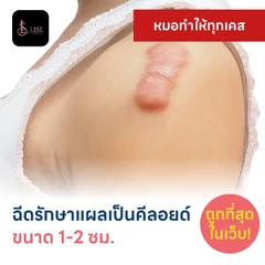 ฉีดรักษาแผลเป็นคีลอยด์ ขนาดเส้นผ่านศูนย์กลาง 1-2 ซม. 1 จุด 1 ครั้ง