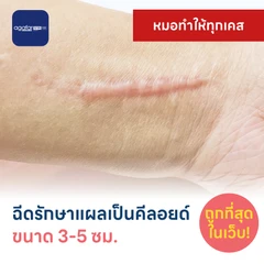 ฉีดรักษาแผลเป็นคีลอยด์ ขนาดเส้นผ่านศูนย์กลาง 3-5 ซม. 1 จุด 1 ครั้ง