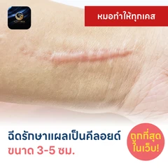 ฉีดรักษาแผลเป็นคีลอยด์ ขนาดเส้นผ่านศูนย์กลาง 3-5 ซม. 1 จุด 1 ครั้ง