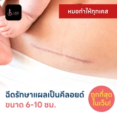 ฉีดรักษาแผลเป็นคีลอยด์ ขนาดเส้นผ่านศูนย์กลาง 6-10 ซม. 1 จุด 1 ครั้ง