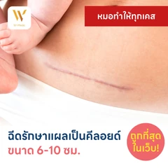 ฉีดรักษาแผลเป็นคีลอยด์ ขนาดเส้นผ่านศูนย์กลาง 6-10 ซม. 1 จุด 1 ครั้ง