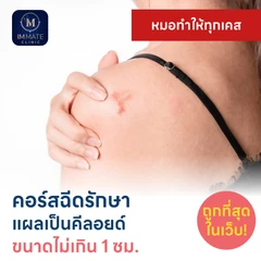 คอร์สฉีดรักษาแผลเป็นคีลอยด์ ขนาดเส้นผ่านศูนย์กลางไม่เกิน 1 ซม. 1 จุด 5 ครั้ง